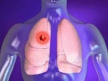Несложный тест на дыхание поможет выявлять рак легких