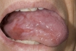 Такролимус эффективен для местного лечения красного плоского лишая с локализацией на слизистой полости рта