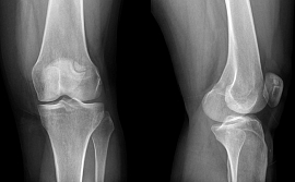 Актуальные рекомендации ESCEO  по лечению остеоартрита  коленного сустава 
