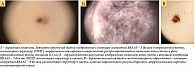 Рис. 7. Оценка дерматоскопических изображений акральных меланоцитарных образований