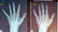 Рис. 2. Рентгенологическое прогрессирование заболевания у пациента 65 лет на фоне терапии (А – 2013 г., Б – 2016 г.)