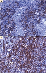 Рис. 3. Выявление маркеров апоптоза в клетках опухолевого очага после сеанса ФДТ у больной К. 54 лет  (А – иммуногистохимическое выявление каспазы-3,  Б – CD95, 400-кратное увеличение)