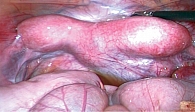 Рис. 7. Диагностическая лапароскопия: порок развития половых органов, двурогая матка