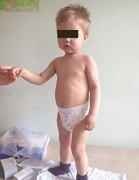 Рис. 2. Внешний вид ребенка в возрасте двух лет на фоне комплексного лечения