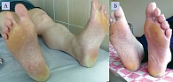 Рис. 2. Пациент Б. с гиперкератозом кожных покровов (А – исходно, Б – через 14 дней терапии)