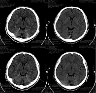 Рис. 2. КТ головного мозга с внутривенным контрастированием до лечения (19 мая 2006 г.) и после двух курсов ПХТ (19 июля 2006 г.). Полная регрессия (19 мая 2006 г. в височных областях с обеих сторон очаги 0,5 и 0,6 см)
