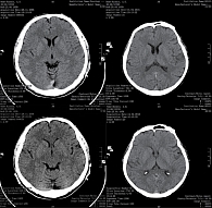 Рис. 4. КТ головного мозга с внутривенным контрастированием после шести курсов ПХТ  (29 ноября 2006 г.) и через десять лет (14 апреля 2016 г.). Полная регрессия сохраняется