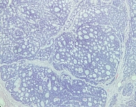 Рис. 1. Аденокистозный рак молочной железы криброзного строения (окрашивание гематоксилином и эозиом, увеличение ×20)