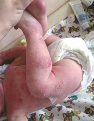 Рис. 1. Атопический дерматит, распространенная форма, тяжелое течение, осложненное вторичным инфицированием (возраст – шесть месяцев)