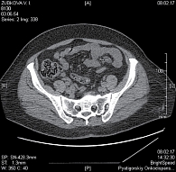 Рис. 2. Рентгеновская компьютерная томография органов малого таза