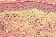 Рис. 6. Гистологическая картина синдрома Шнитцлера – нейтрофильная инфильтрация дермы без васкулита и значительного отека