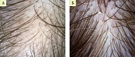 Рис. 3. Волосистая часть головы пациента К. до  (А) и через три месяца лечения (Б)