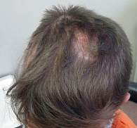 Рис. 1. Очаг микроспории на волосистой части головы с минимальным воспалительным компонентом