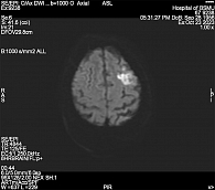Рис. 6. Зоны измененного сигнала в режиме DWI в левом полушарии головного мозга (ограничение диффузии) у пациентки Д., 67 лет, с острым ишемическим инсультом, острый период
