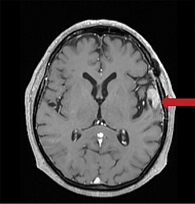 Рис. 3. МРТ головного мозга от июня 2017 г.: уменьшение образования до размеров 23 × 22 × 13 см без признаков перифокального отека