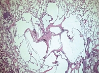 Рис. 2. Гистиоцитоз из клеток Лангерганса на конечной стадии с центральным звездчатым рубцом, соседними кистозными изменениями и окружающей нормальной паренхиматозной тканью легкого (окраска гематоксилином и эозином, исходное 16-кратное увеличение)