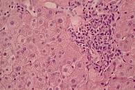 Рис. 1. Дистрофия гепатоцитов, лобулярный гепатит, наличие оптически пустых ядер (окраска гематоксилином и эозином, 500-кратное увеличение)