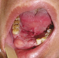 Рис. 1. Плоскоклеточный рак слизистой оболочки дна полости рта смешанной формы роста, распространяющийся на нижнюю челюсть
