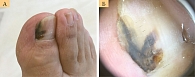 Рис. 4. Больная В., 61 год: акральная лентигинозная меланома (клиническое (А) и дерматоскопическое (Б) изображение)
