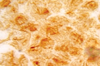 Рис. 4. Иммуногистохимическое исследование: скопление опухолевых клеток, положительная экспрессия виментина (900-кратное увеличение)