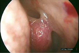 Клинико-анатомические особенности средней носовой раковины, влияющие на течение хронического синусита