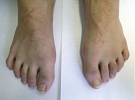 Рис. 6. Пациент Ж. через три месяца лечения. Дактилиты второго – пятого пальцев правой стопы, дактилит третьего пальца левой стопы