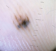 Рис. 6. Больная Ж., 48 лет: ранняя акральная лентигинозная меланома кожи стопы, максимальный линейный размер – 4 мм, стадия IА (дерматоскопическое изображение)