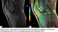 Рис. 2. Изображение коленного сустава пациента с ранним ОА  (А – МРТ, Б – МРТ с Т2-картированием)