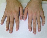 Рис. 3. Пациент Ж. до лечения. Артрит суставов пятого пальца левой кисти, сгибательная контрактура