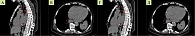 Рис. 4. Компьютерная томограмма органов грудной клетки с визуализацией первичной меланомы в просвете пищевода (А – сагиттальная проекция; Б – аксиальная проекция; В, Г – измененные регионарные лимфоузлы)