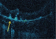 Рис. 4. Изображение оптического среза сетчатки (желтая стрелка – гиперрефлективные фокусы на уровне пигментного эпителия)