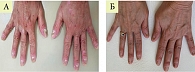 Рис. 3. Пациентка Б. с вульгарным псориазом и псориатической ониходистрофией до лечения (NAPSI 44) (А) и через пять месяцев (NAPSI 4) (Б)