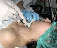 Пациентке делают биопсию щитовидной железы с помощью аспирации тонкой иглой