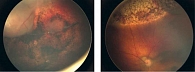 Рис. 3. Изображение глазного дна (секторальная хориоретинальная атрофия) у пациентов с РБ на фоне НПХТ и ИВХТ