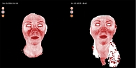 Рис. 1. Данные визиосканирования у пациентки первой группы до и после применения импульсного лазера на красителе (595 нм)
