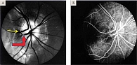 Рис. 11. Краевая вена Краупа (красная стрелка), ретинопиальная вена (желтая стрелка) у пациента с глубокими друзами ДЗН (А),  ФАГ, артериовенозная фаза (Б)