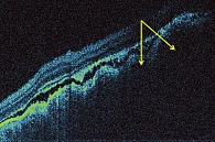 Рис. 7. Томографический скан (оптическая когерентная томография) метастаза меланомы кожи. Неровный хориоидальный профиль в зоне образования, диффузный отек и расслоение нейроэпителия сетчатки над опухолью, серозная отслойка нейроэпителия, интраретинальные