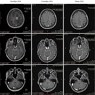 Рис. 6. Динамика метастатического поражения головного мозга по данным МРТ на фоне лечения комбинацией дабрафениб + траметиниб