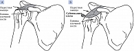 Плечевой сустав (А – нормальная анатомия плечевого сустава, Б – сублюксация головки плечевой кости)