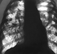 Рис. 3. Рентгенограмма при узловой форме силикоза