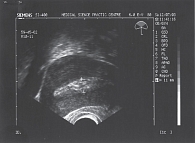 Рис. 1. М-эхо шириной 10 мм. Полость матки заполнена гипоэхогенным содержимым с наличием эхопозитивной взвеси. Заключение: состояние после медикаментозного аборта (наблюдение и фото автора)