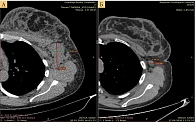 Рис. 2. Метастазы в левых подмышечных лимфоузлах с выраженной положительной динамикой (А – до лечения, Б – через пять месяцев терапии)