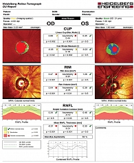 Рис. 15. HRT: OD – далеко зашедшая стадия глаукомы (увеличен размер экскавации, резкое снижение толщины СНВС), OS – начальная стадия глаукомы (уменьшение толщины СНВС)