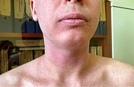 Рис. 10. На фоне лечения дупилумабом практически полностью исчезли гиперемия кожи, трещины в области губ