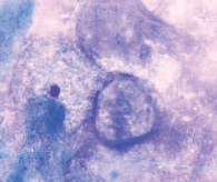 Рис. 5. Микроскопическая картина при бактериальном вагинозе. По данным ПЦР-диагностики – выраженный дисбиоз