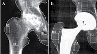 Рис. 1. Произвольно выделенные субрегионы костей таза и проксимального отдела правой бедренной кости до эндопротезирования (А) и после (Б)