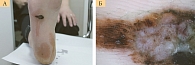 Рис. 2. Больная В., 58 лет: акральная меланома (клиническое (А) и дерматоскопическое (Б) изображение)