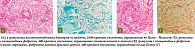 Рис. 4. Саркоидозные гранулемы в брюшине (фрагменты предыдущего рисунка): мономорфные несливающиеся гранулемы без некроза и лейкоцитов в центре, четко очерченные, «штампованного» вида, 200-кратное увеличение, окрашивание гематоксилином и эозином