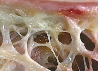 Рис. 2. Гиподерма после удаления жирового компонента (в поле зрения соединительнотканные тяжи с проходящими в них сосудами, коллатеральные сосуды, лимфатические капилляры)