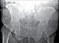 Рис. 10. Рентгенограмма таза при сакроилиите четвертой стадии